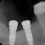 2098181559 763fc6e175 150x150 - Dental Implants Columbus Ohio