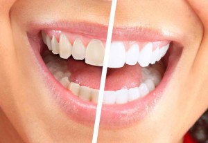 What Triggers Tooth Discoloration 300x207 - What Triggers Tooth Discoloration