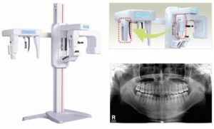 Spot the Problem thru CEPH Dental X ray 300x181 - Spot the Problem thru CEPH Dental X-ray