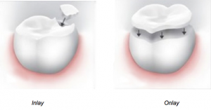 Dental Inlays Healthy Facts Perks 300x157 - Dental Inlays' Healthy Facts &amp; Perks