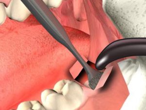 Facts to Learn from Wisdom Teeth Extraction 300x225 - Facts to Learn from Wisdom Teeth Extraction