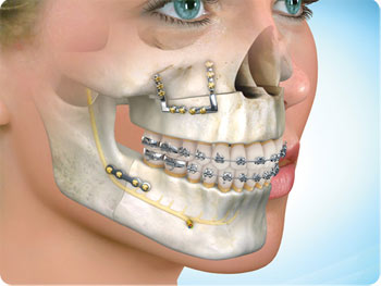Things to Expect from Oral Maxillofacial Surgery