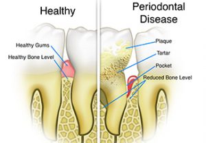 Deeply Rooted Details of Periodontal Disease 300x208 - Deeply Rooted Details of Periodontal Disease