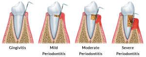 Warning Factors Indications of Gum Disease 300x117 - Warning Factors &amp; Indications of Gum Disease