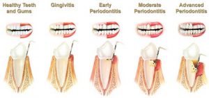 Warning Factors Indications of Gum Disease2 300x141 - Warning Factors &amp; Indications of Gum Disease