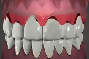 Dental Perils of Having Trench Mouth 300x198 - Dental Perils of Having Trench Mouth