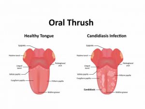 Dental Risks Found in Oral Thrush 300x225 - Dental Risks Found in Oral Thrush