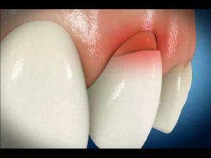 Dental Abrasion Adverse Effect of Excessive Brushing0 300x225 - Dental Abrasion: Adverse Effect of Excessive Brushing